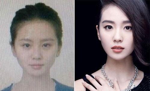 明星牙套前后对比照,见证微笑的力量